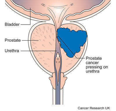 Prostate-Cancer-Symptoms